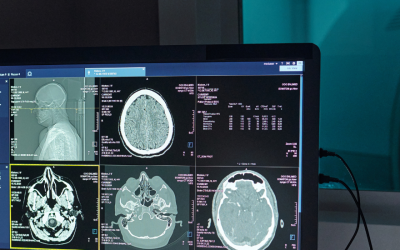 Ask the Expert: How Does Preeclampsia Affect the Brain?