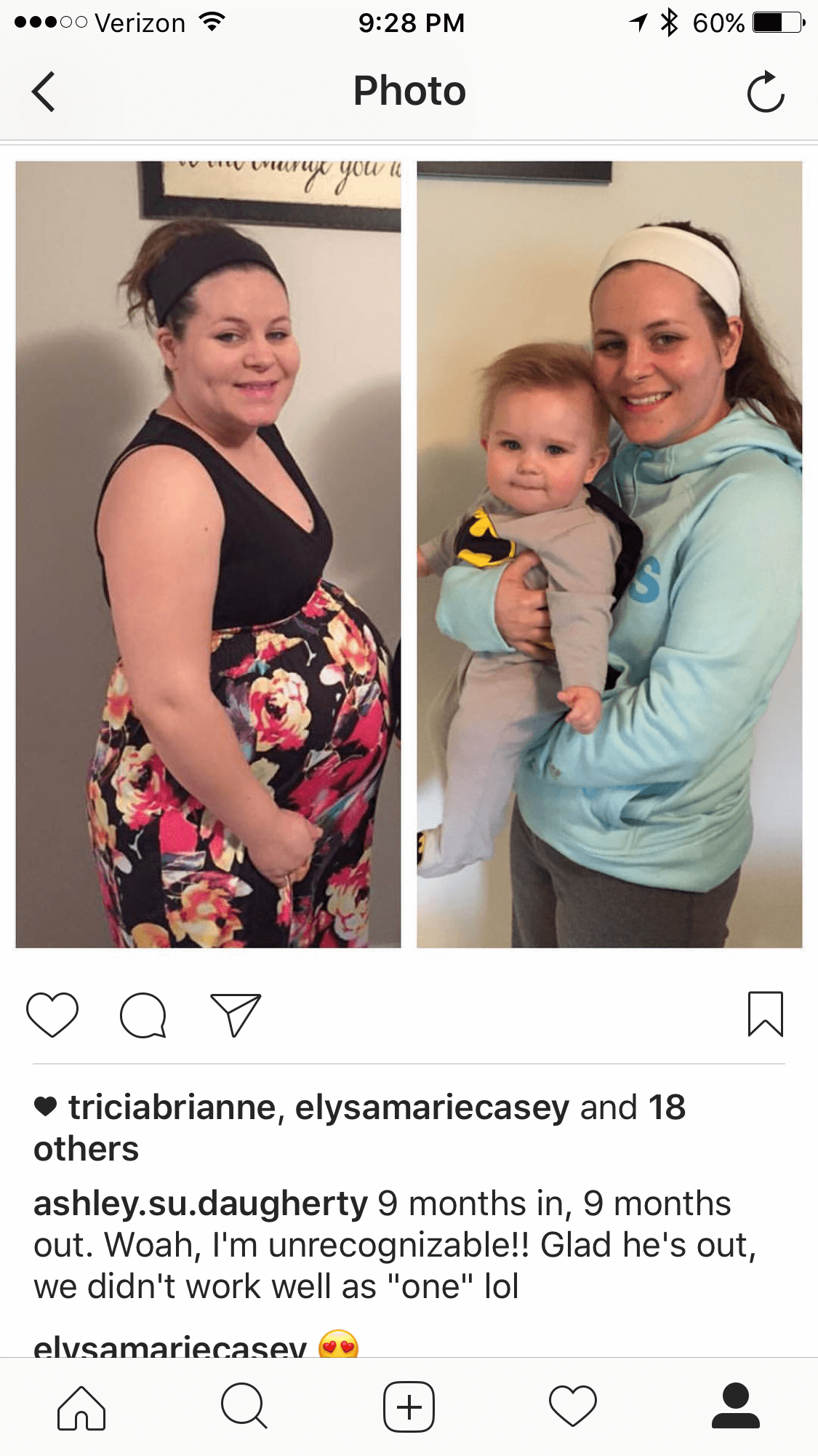 Preeclampsia with missed pulmonary edema