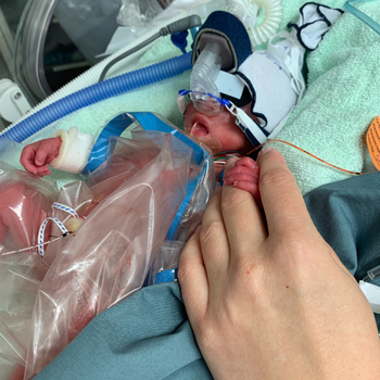 Early Onset Preeclampsia and HELLP Syndrome