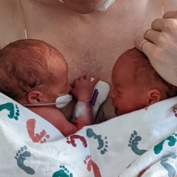 IVF, Twins, HELLP & Liver Rupture